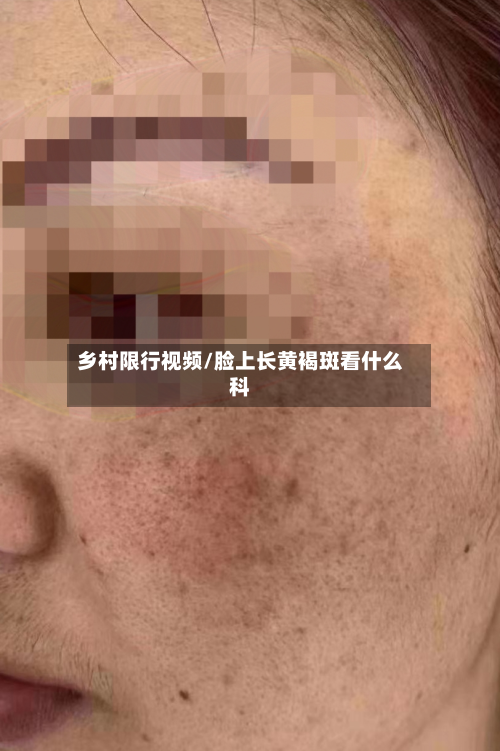 乡村限行视频/脸上长黄褐斑看什么科